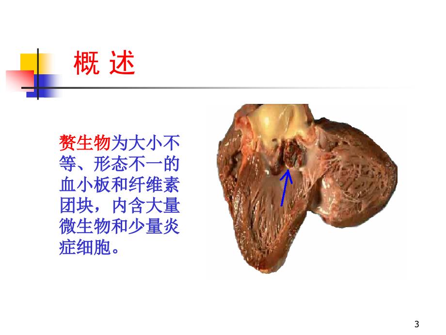 感染性心内膜炎2学时ppt课件_第3页