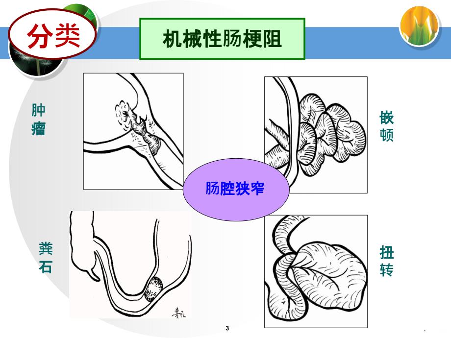 麻痹性肠梗阻查房PPT课件_第3页