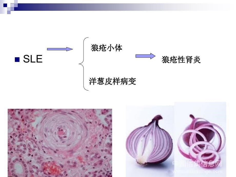 狼疮性肾炎教学查房_第5页