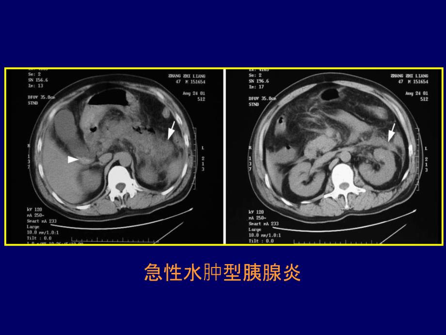 胰腺胆囊影像知识ppt课件_第4页