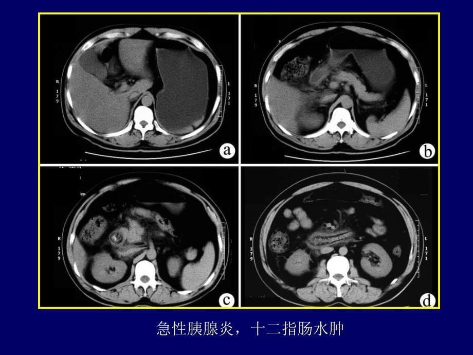 胰腺胆囊影像知识ppt课件_第5页