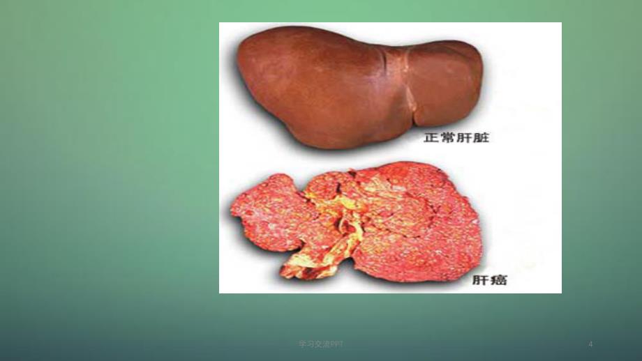 肝癌TACE术后的护理ppt课件_第4页