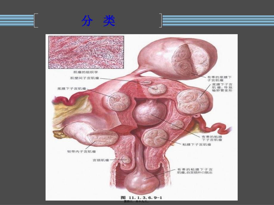 医学专题—子宫射频消融_第4页