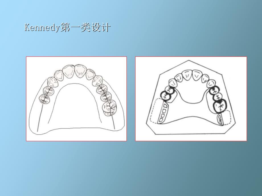 活动义齿设计_第3页