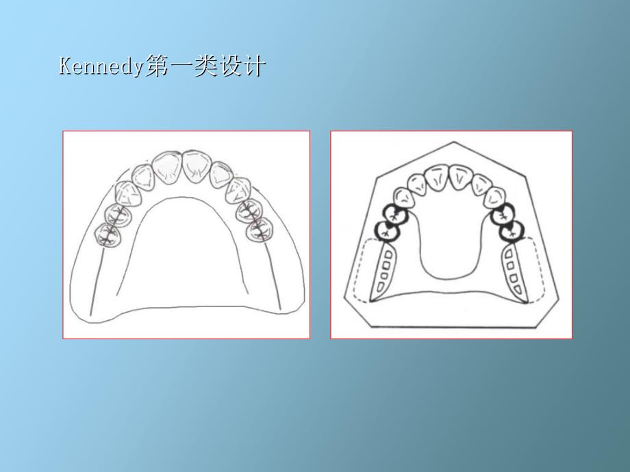 活动义齿设计_第4页