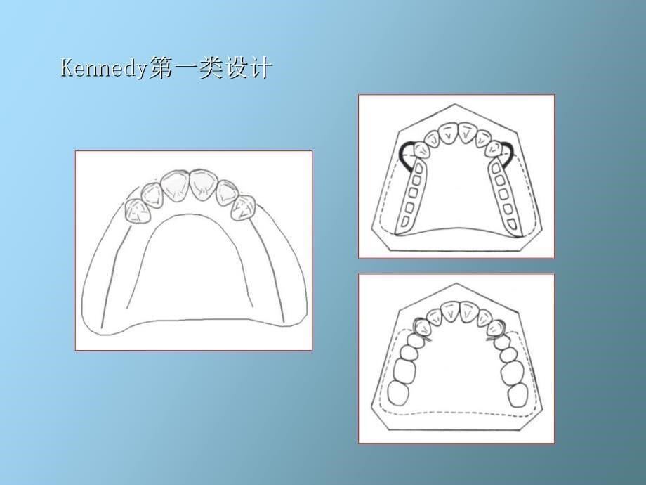 活动义齿设计_第5页