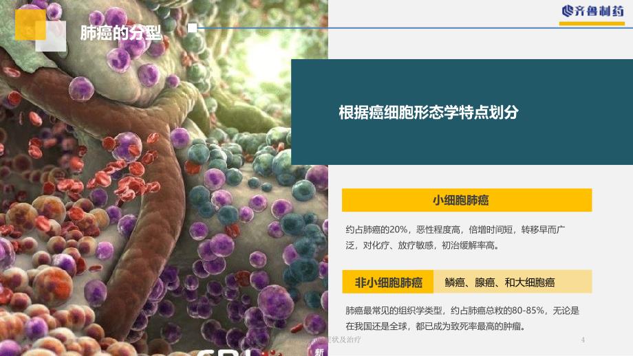 肺癌不同时期的症状及治疗课件_第4页