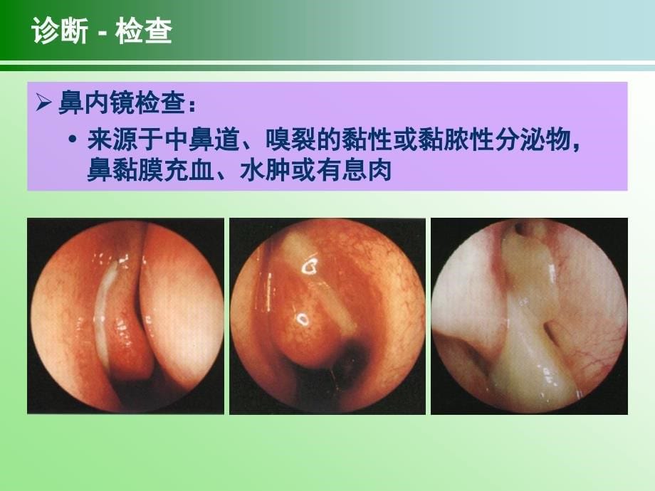 慢性鼻鼻窦炎治疗指南2012昆明_第5页