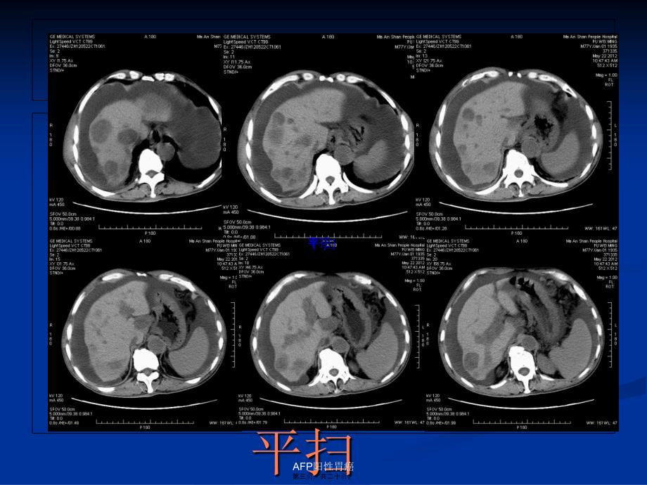 AFP阳性胃癌课件_第3页