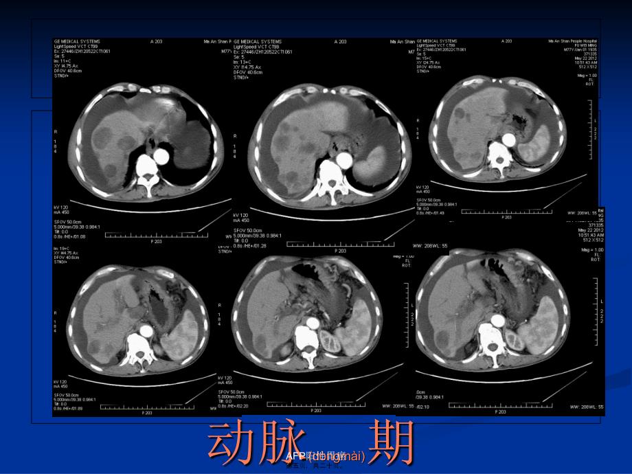 AFP阳性胃癌课件_第5页