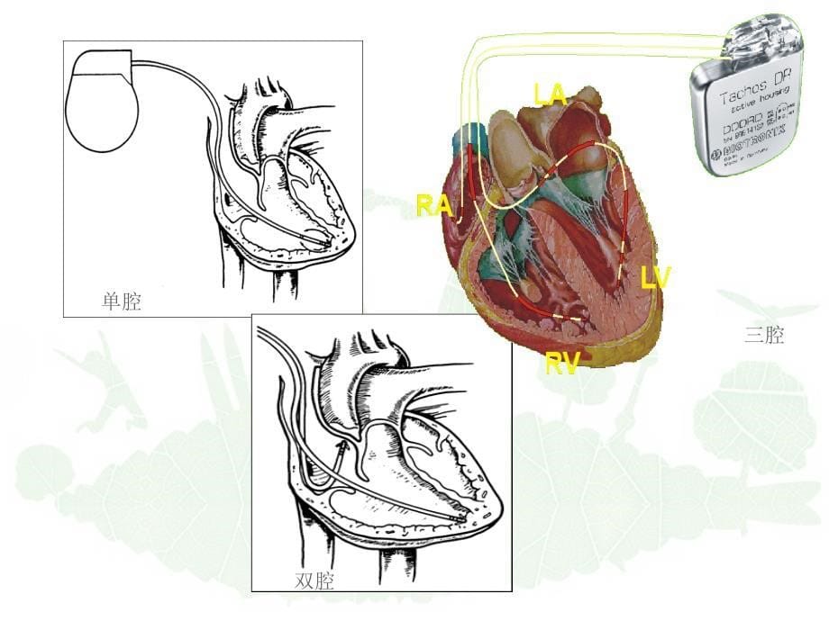 《心脏起搏器治疗》PPT课件_第5页