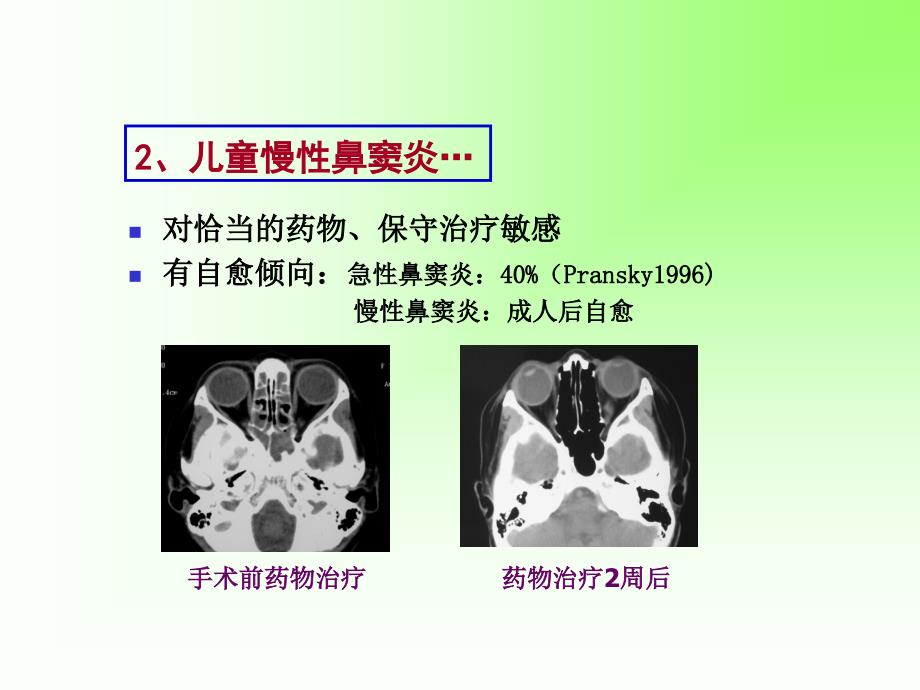 《儿童鼻窦炎》PPT课件_第4页