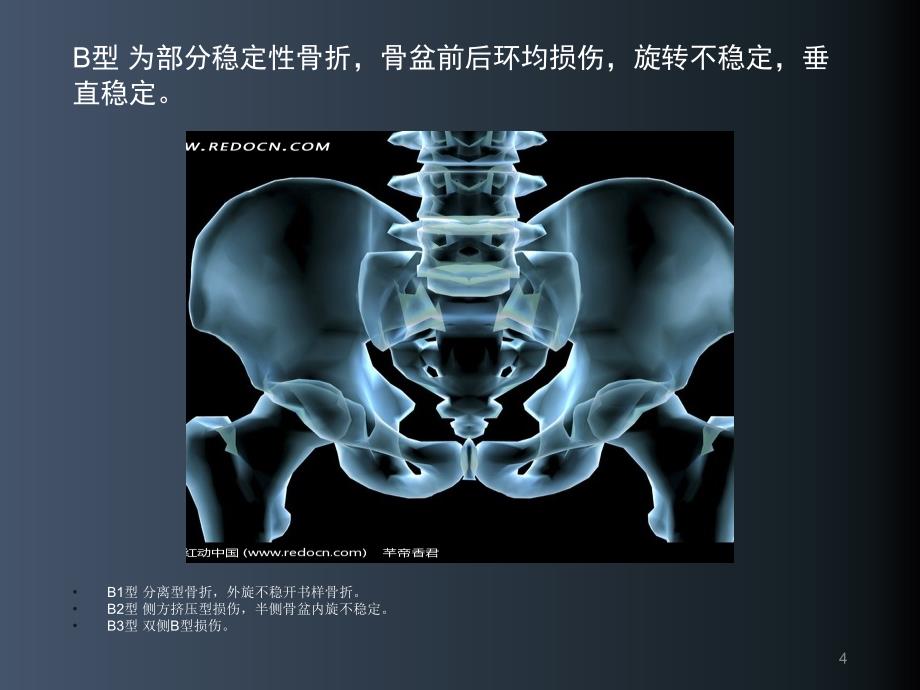 骨盆骨折护理常规幻灯片课件_第4页