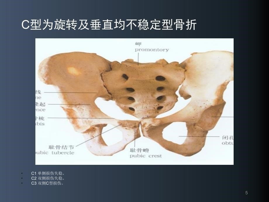 骨盆骨折护理常规幻灯片课件_第5页