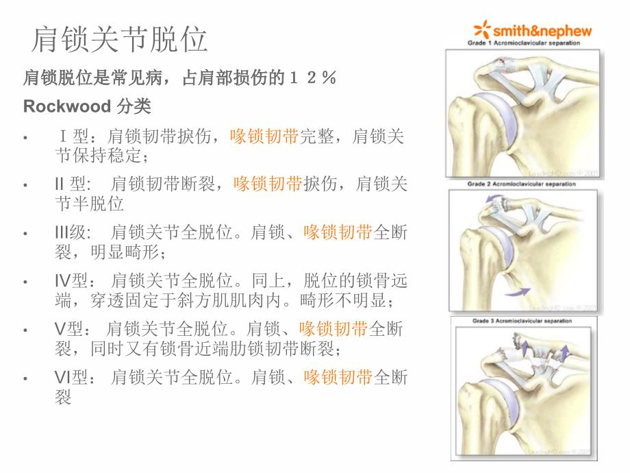 双ENDOBUTTON技术重建肩锁关节.ppt_第4页