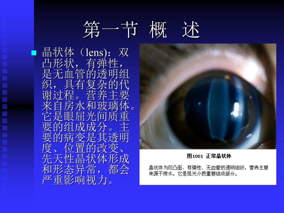 眼科学课件：第十章 晶状体病_第2页