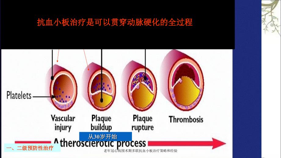 老年冠心病围术期多联抗血小板治疗策略和经验课件_第2页