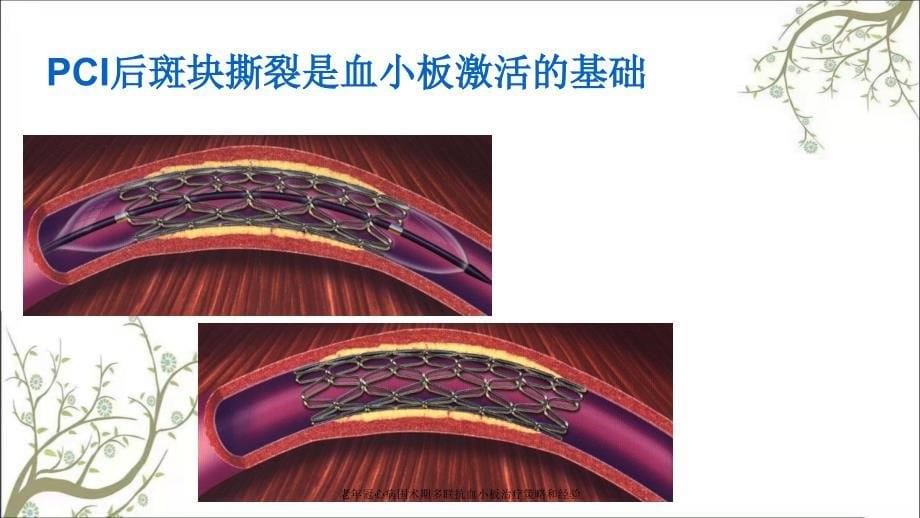 老年冠心病围术期多联抗血小板治疗策略和经验课件_第5页