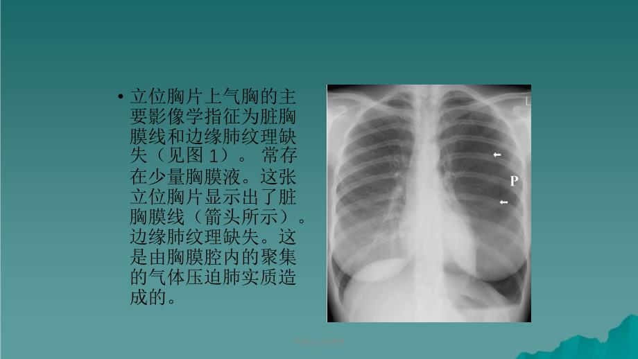 气胸的X线表现课件_第3页