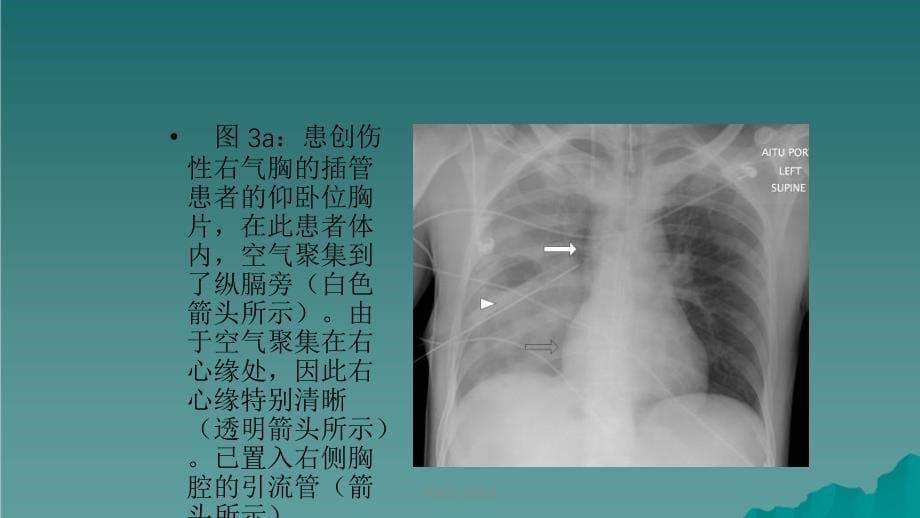 气胸的X线表现课件_第5页