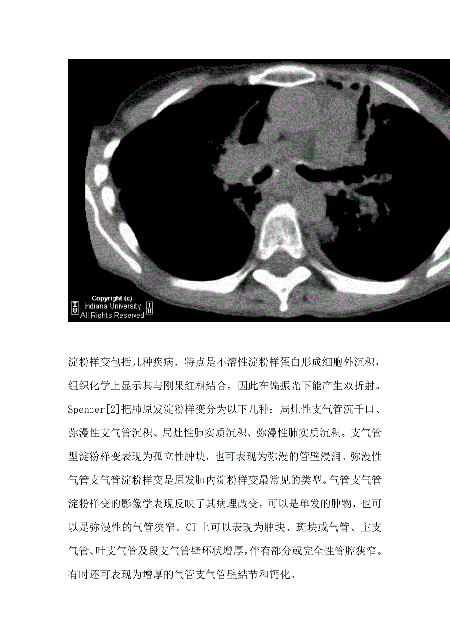 支气管淀粉样变性.doc_第3页