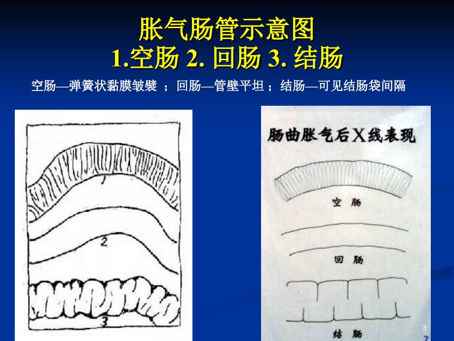 推荐精选肠梗阻的分类及影像学表现_第3页