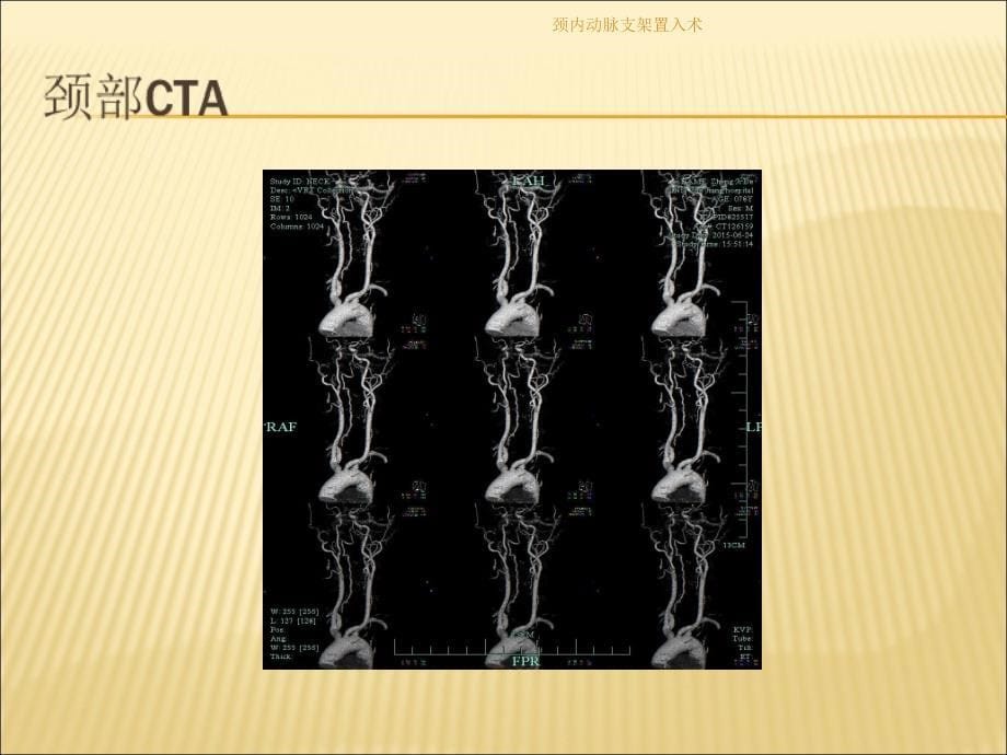颈内动脉支架置入术课件_第5页