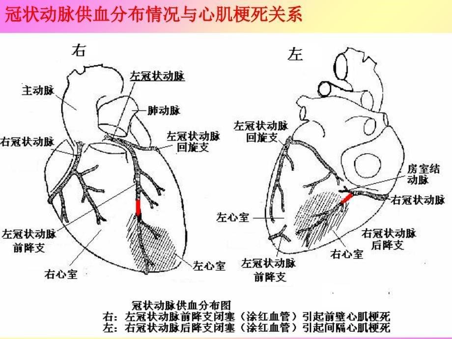 急性心肌梗死心电图演变_第5页