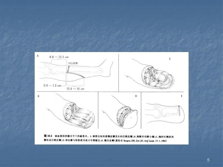 截肢后的康复ppt课件_第5页
