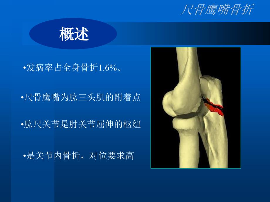 尺骨鹰嘴骨折_第3页