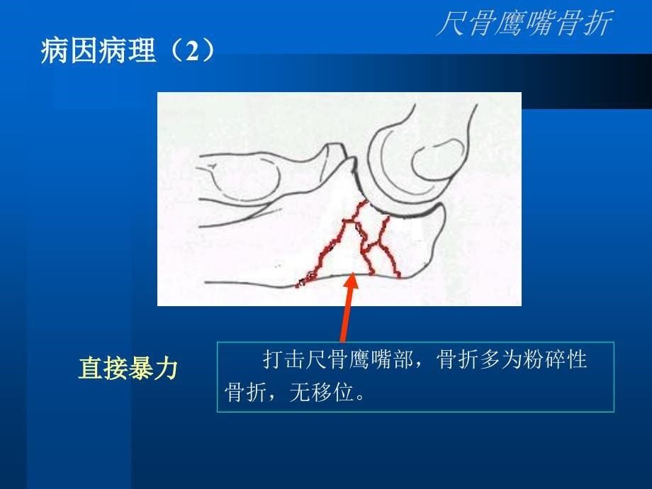 尺骨鹰嘴骨折_第5页