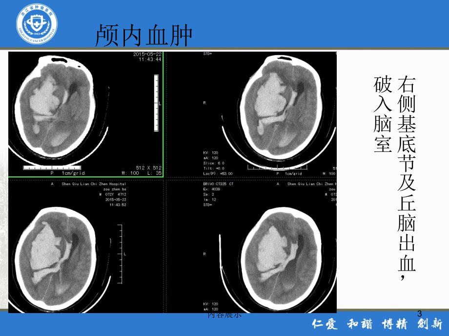 危急值---CT 肿瘤医院放射科【专业技术】_第3页