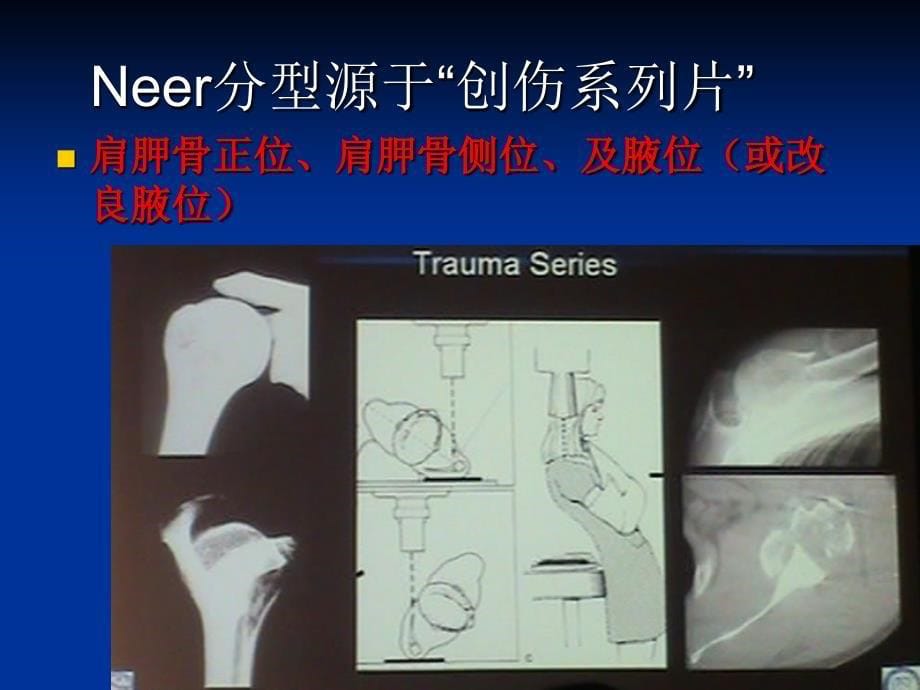 肱骨近端骨折Neer分型及治疗_第5页