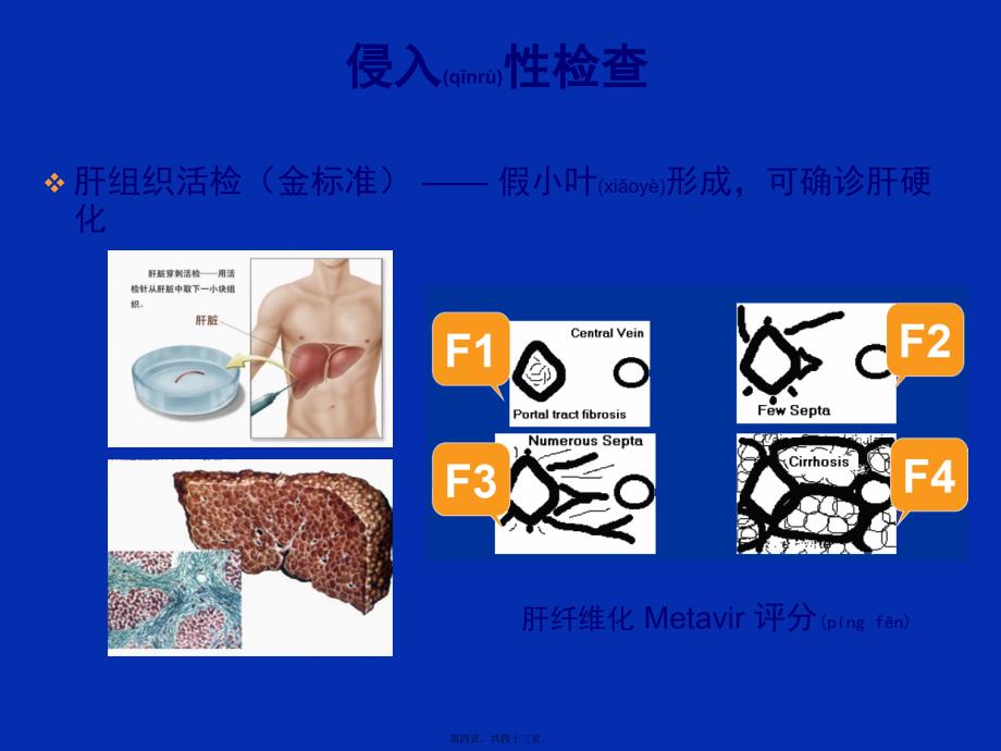 医学专题—乙肝肝硬化并发症的处理34074_第4页