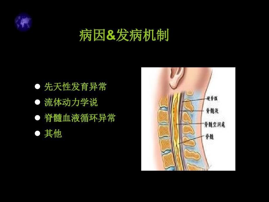 脊髓空洞症MRI表现_第5页