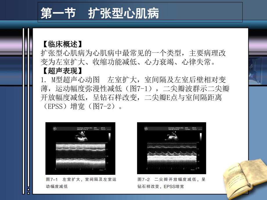 心肌病超声诊断_第2页