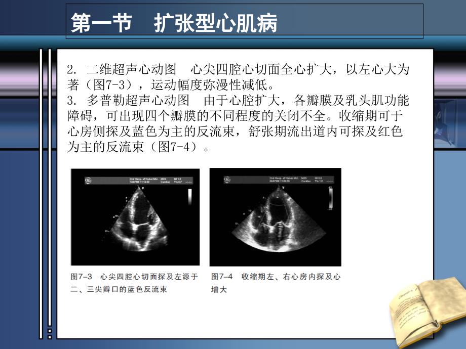 心肌病超声诊断_第3页