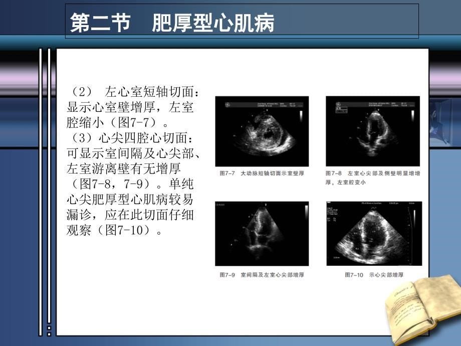 心肌病超声诊断_第5页