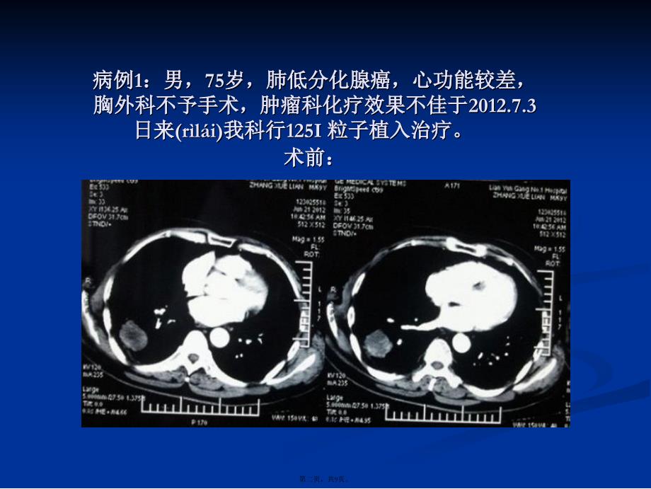 SPECTCT引导下粒子植入治疗实体肿瘤学习教案_第2页