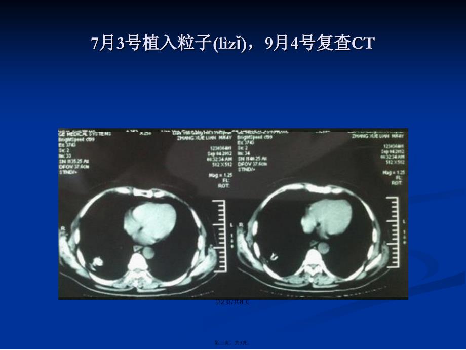 SPECTCT引导下粒子植入治疗实体肿瘤学习教案_第3页