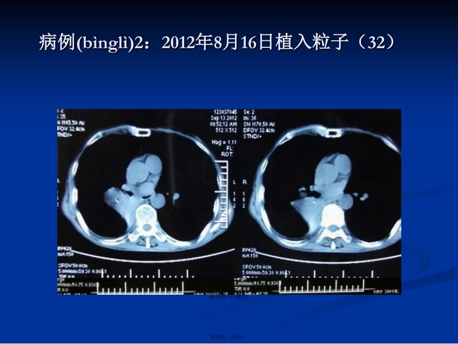 SPECTCT引导下粒子植入治疗实体肿瘤学习教案_第4页