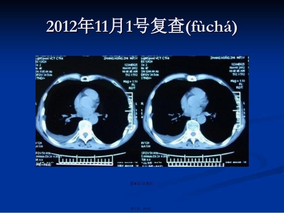 SPECTCT引导下粒子植入治疗实体肿瘤学习教案_第5页