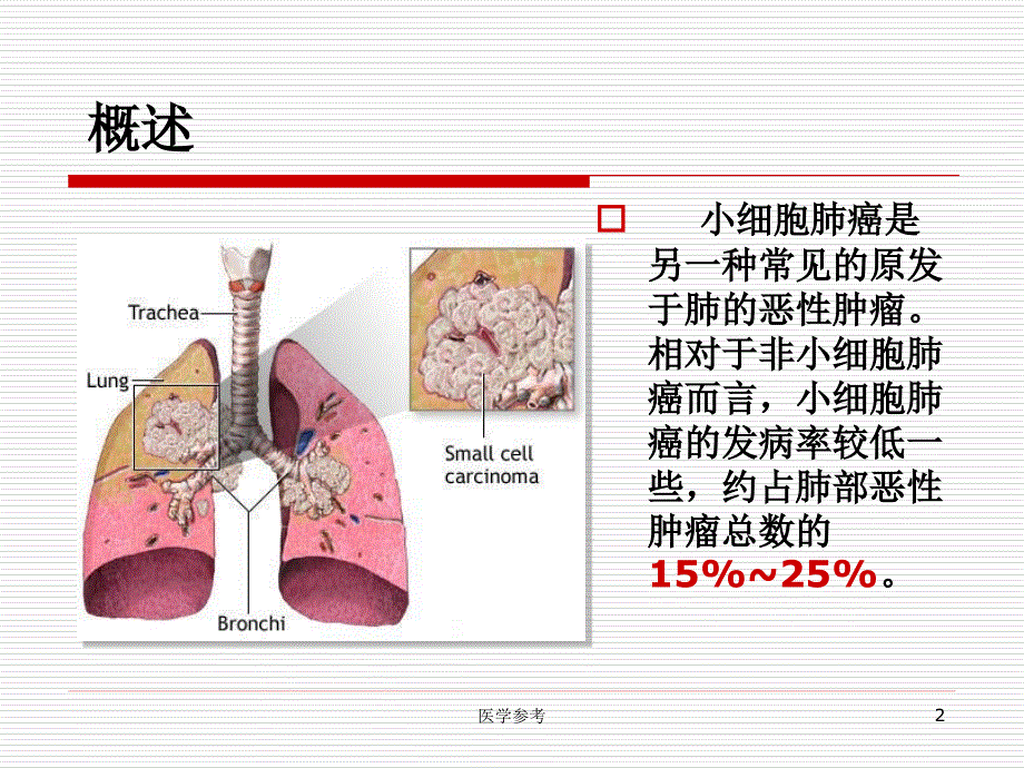 小细胞肺癌【内容充实】_第2页