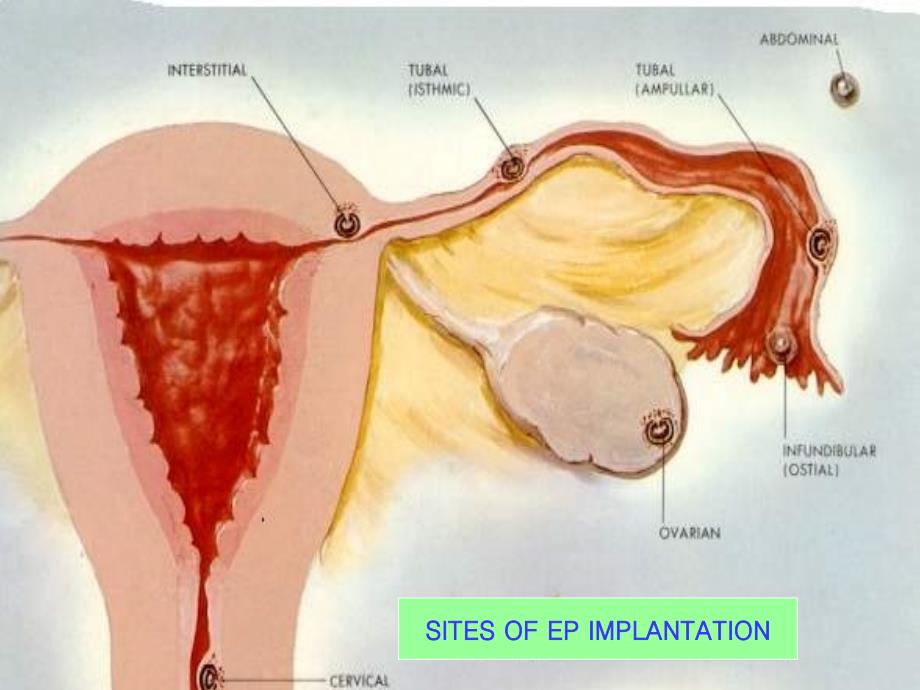 《异位妊娠》PPT课件_第4页