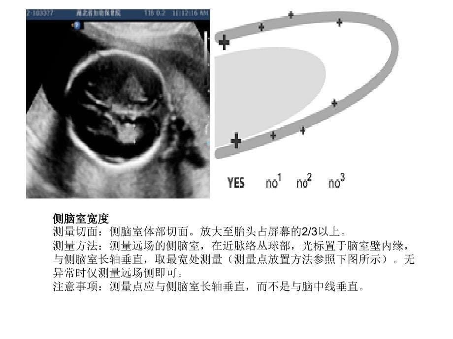 产科超声标准切面25张图课件_第5页