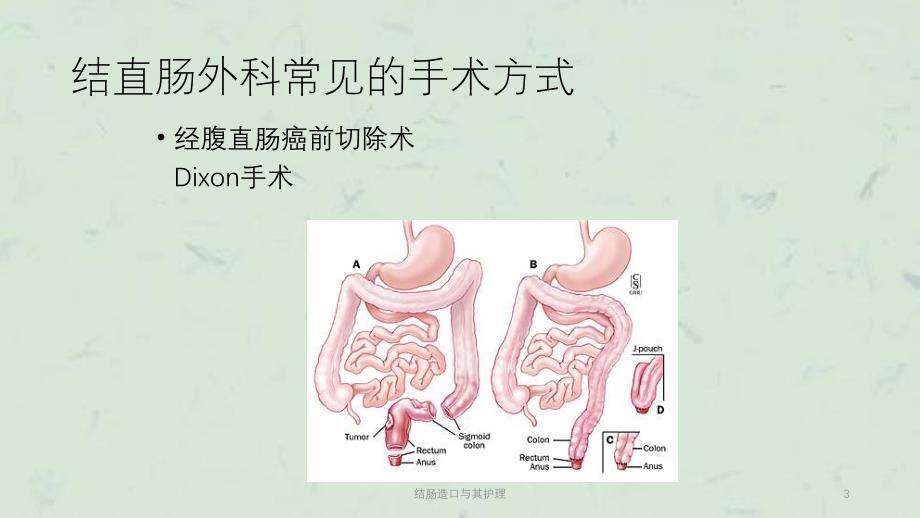 结肠造口与其护理课件_第3页