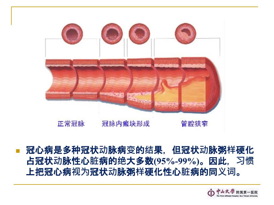 冠心病外科治疗现状课件_第3页