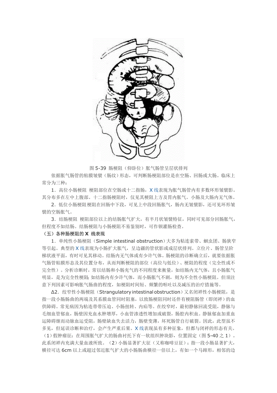 肠梗阻(Intestinal obstruction)X线诊断 (2).doc_第3页