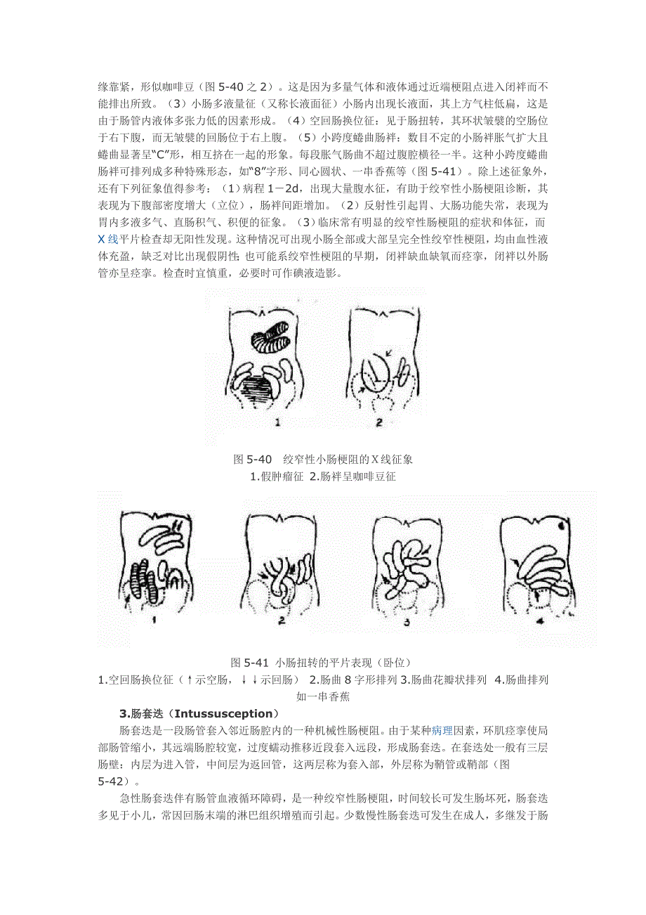 肠梗阻(Intestinal obstruction)X线诊断 (2).doc_第4页