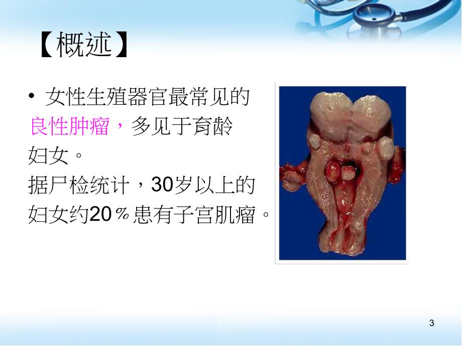 （优质课件）子宫肌瘤病人的术前术后护理_第3页